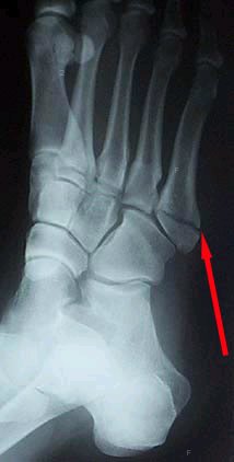 fifth metatarsal.jpg